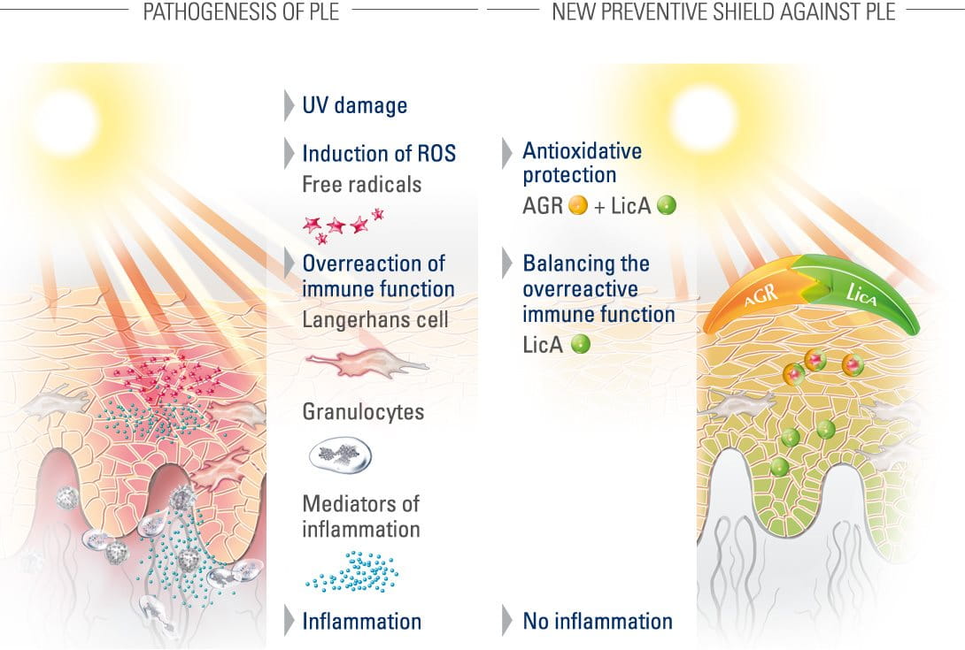 Zonneallergie: Symptomen & Hoe Te Behandelen | Eucerin